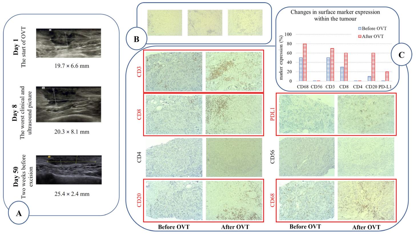 Figure 2. Imaging evidence of the effect of oncolytic virotherapy (OVT).