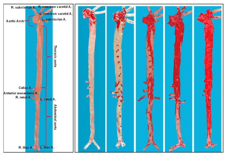 Gross lesions of aortic atherosclerosis in cholesterol-fed rabbits.